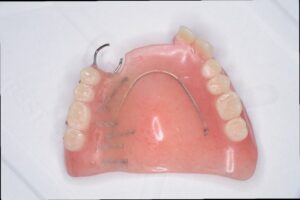 不安定な入れ歯の画像